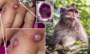 Nigeria hit with monkeypox epidemic, as CDC confirms 21 cases.